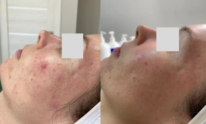 Азелаиновый пилинг